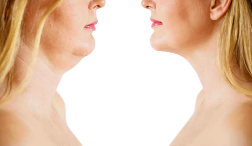 Double Chin treatment Midhurst before and after results
