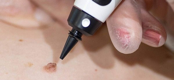 After Skin Tag Removal Midhurst