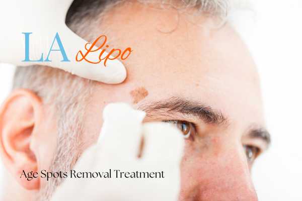 What Are the Most Effective Treatments for Age Spots Midhurst?