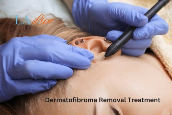 Dermatofibroma Removal Treatment Midhurst