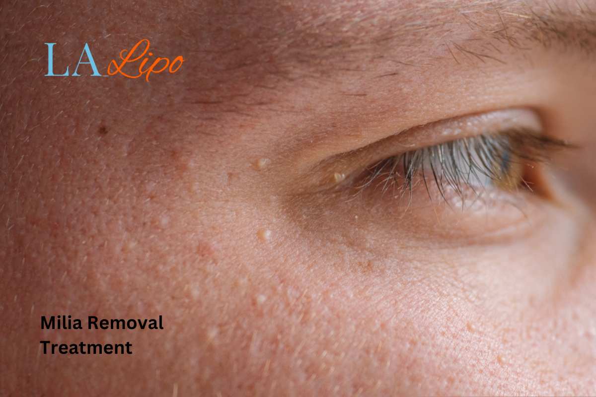 Cryopen Milia Removal: Is It the Easiest and Safest Option Midhurst?