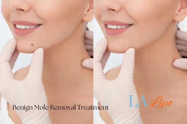 Before-and-after results following benign mole-removal treatment Midhurst