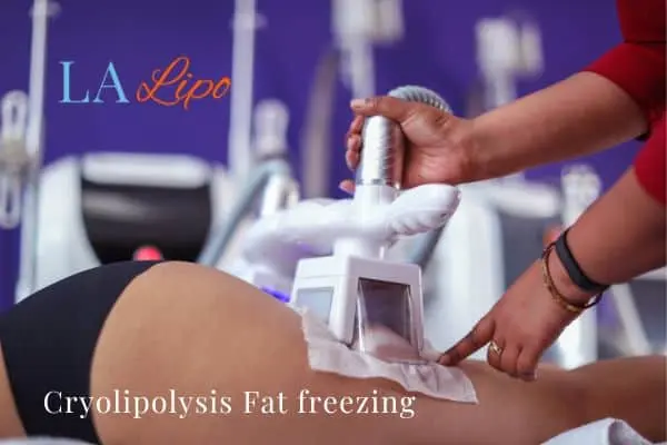 women getting fat freezing Midhurst