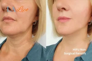 hi-fu for wrinkles Midhurst before and after results