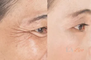 Before and after results of woman - HI-fu wrinkles reduction treatment Midhurst