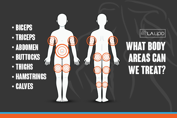Graphic to show areas you can have LA-EMS Body Sculpting Midhurst treatment.