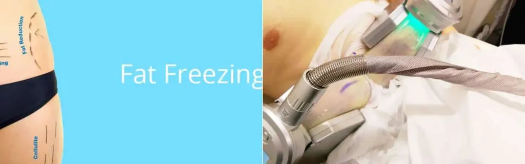 Fat freezing Midhurst on multiple areas of the body