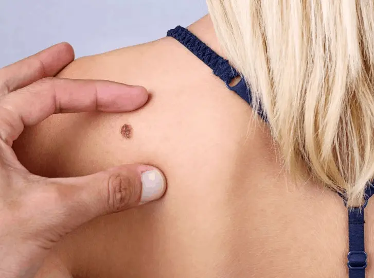 woman having mole removal Midhurst consultation before treatment.