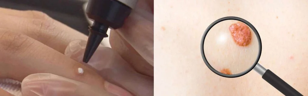 CryoPen practitioner Midhurst assessing a benign mole before treatment