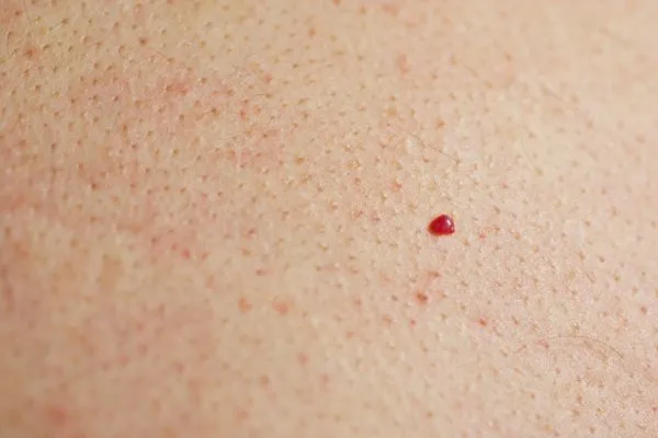 close up of a cherry angioma Midhurst