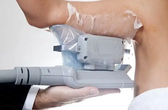 Picture of fat freezing Midhurst on the upper arms.