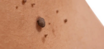 image of a skin tag Midhurst