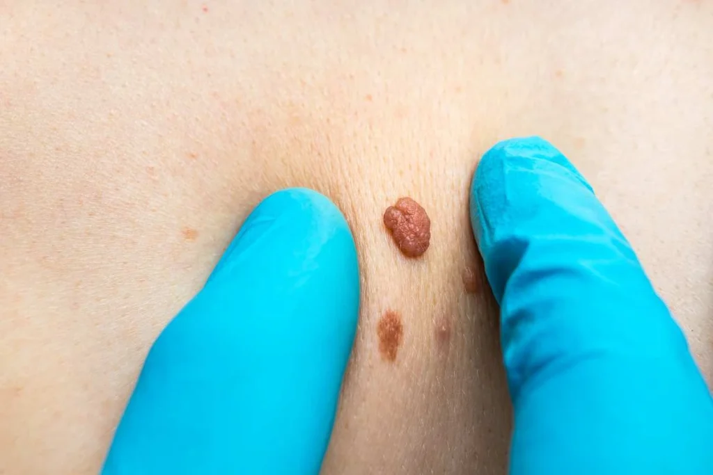 Consultant examining a skin tag Midhurst