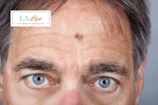 Solar Lentigo Removal Midhurst image of man with mark on his forehead