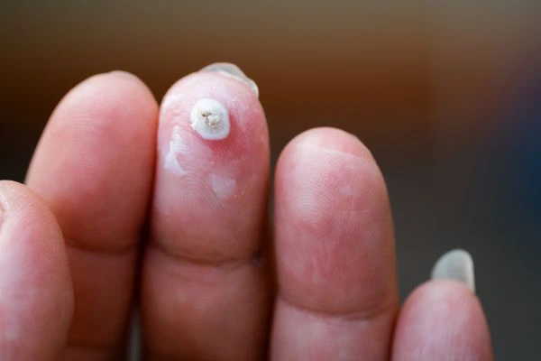 wart on person finger - cryotherapy to treat from LA LIPO Midhurst