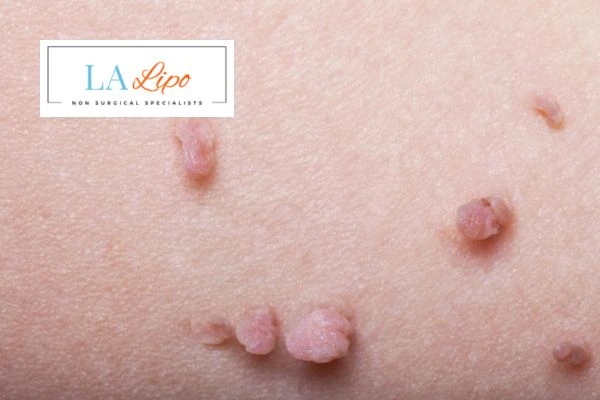 Does cryopen skin tag removal Midhurst hurt? Find out now call our team today!