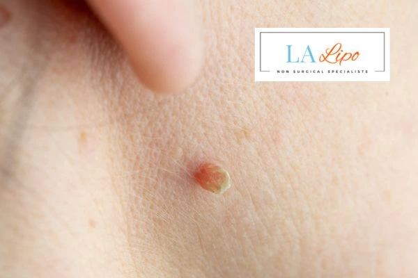 Book skin tag removal Midhurst today speak to our team now!