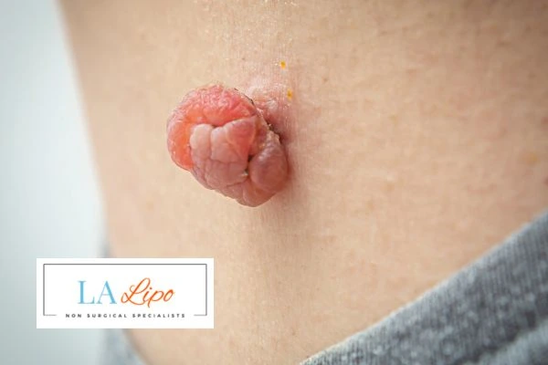 Interested in skin tag removal Midhurst? Concerned about the pain? Find out more today!