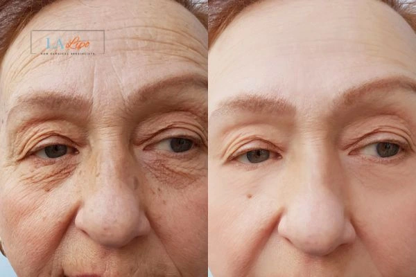 The powerful benefits of Morpheus8 Treatment Midhurst - Call Our team today!