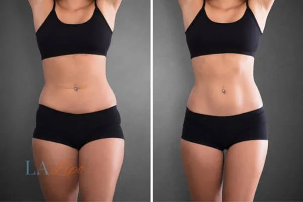 before and after results of non-surgical treatment to help a woman's body image and mental health Midhurst