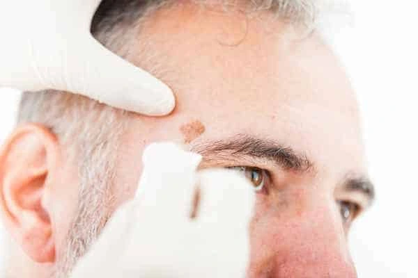 Age spots and elderly people Midhurst what is the link?