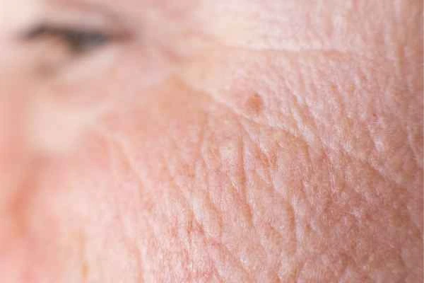 close up picture of a woman's face showing an age spot Midhurst