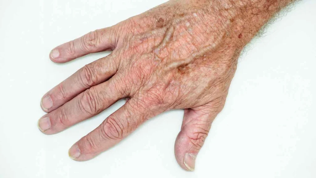 Male hand showing age spot Midhurst