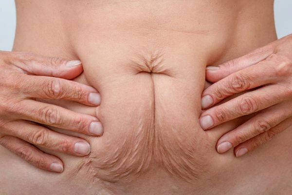 Should I Combine Diastasis Recti Treatment with Body Contouring for Better Results Midhurst?