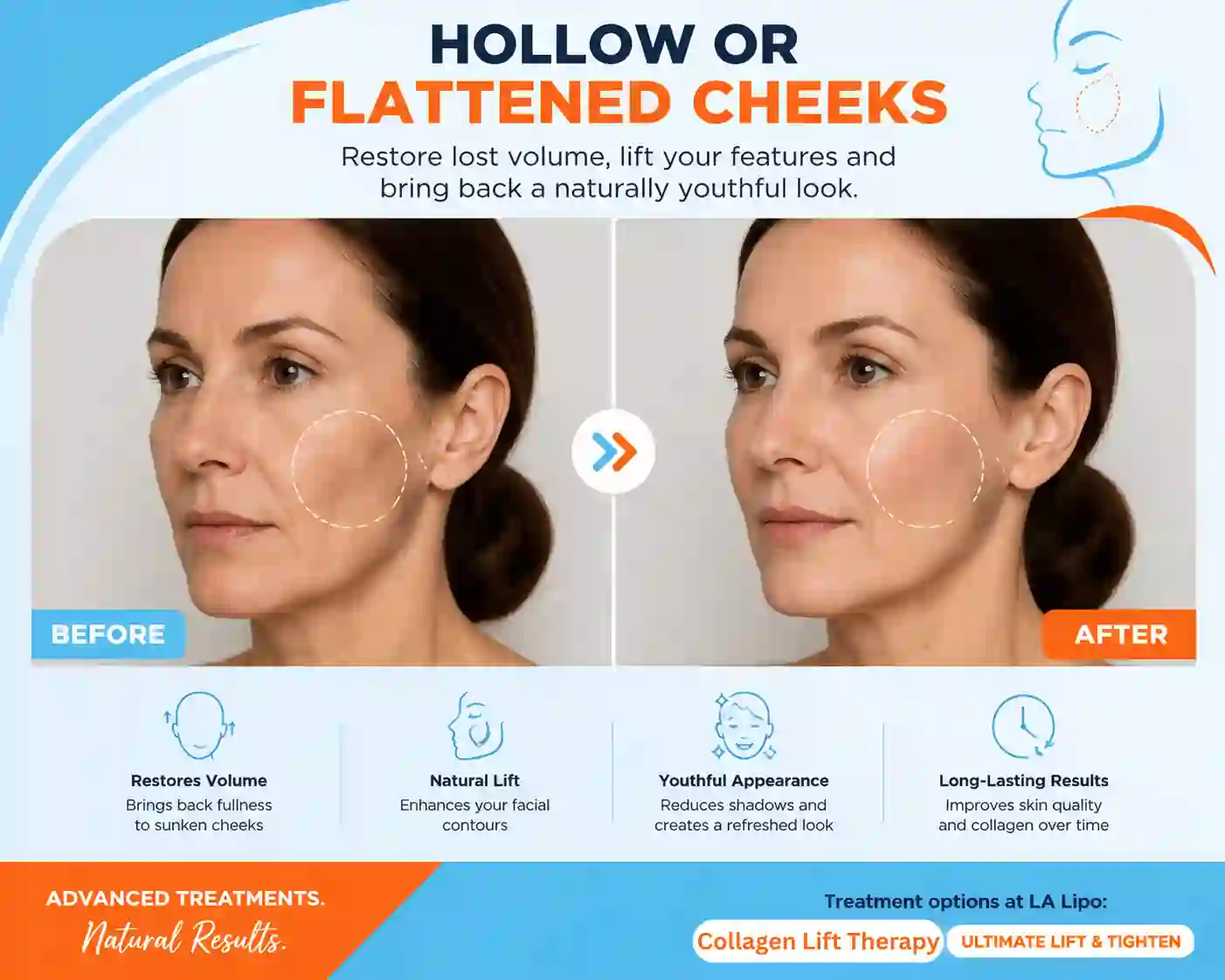 Sign #4: Hollow or Flattened Cheeks Midhurst